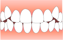 歯並びがでこぼこ