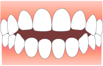 前歯が閉じない