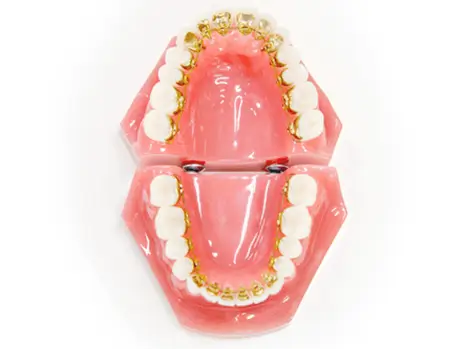 カスタムメイドリンガルブラケット装置を用いた矯正歯科治療