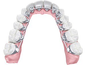 矯正歯科装置（HARMONY）
