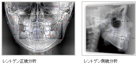 レントゲン正貌・側貌分析