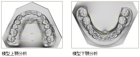 模型上顎・下顎分析