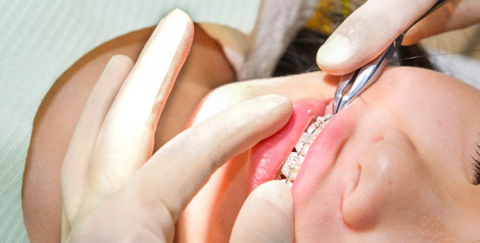 唇側矯正（表側矯正）